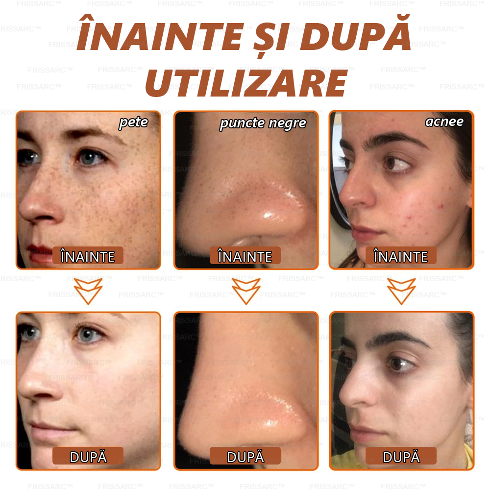 🎁FRISSARC™ masca facială pentru albire și îndepărtarea petelor –🍀Ingredientele naturale ajută la eliminarea eficientă și de durată a petelor pigmentare, petelor de vârstă, pistruilor și petelor solare.🎁