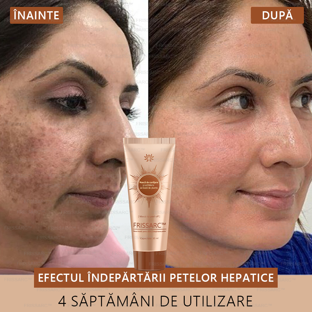 🎁FRISSARC™ masca facială pentru albire și îndepărtarea petelor –🍀Ingredientele naturale ajută la eliminarea eficientă și de durată a petelor pigmentare, petelor de vârstă, pistruilor și petelor solare.🎁