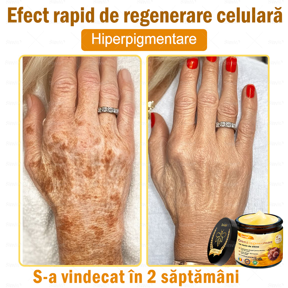 🎁🐝 Crema regeneratoare Sinvie® cu venin de albine 🔥– 50 ml🎁
