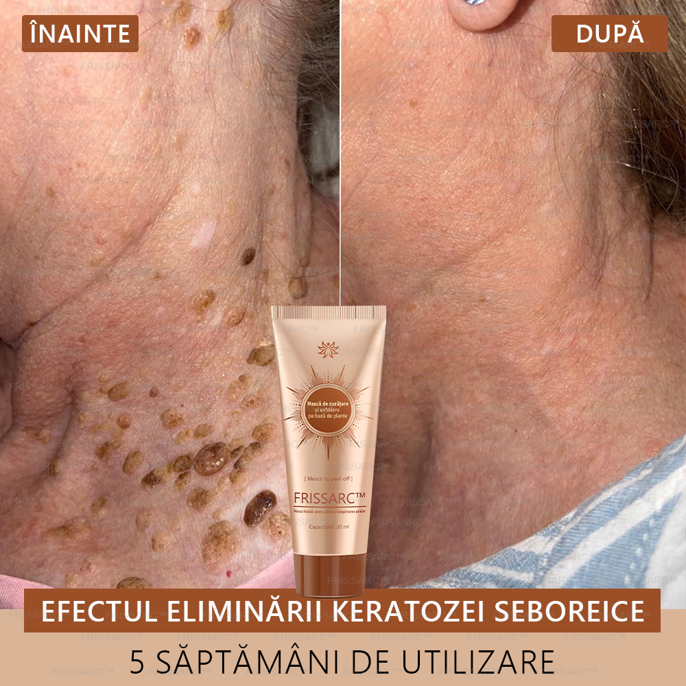 🎁FRISSARC™ masca facială  pentru albire și îndepărtarea petelor –🍀Ingredientele naturale ajută la eliminarea eficientă și de durată a petelor pigmentare, petelor de vârstă, pistruilor și petelor solare.🎁