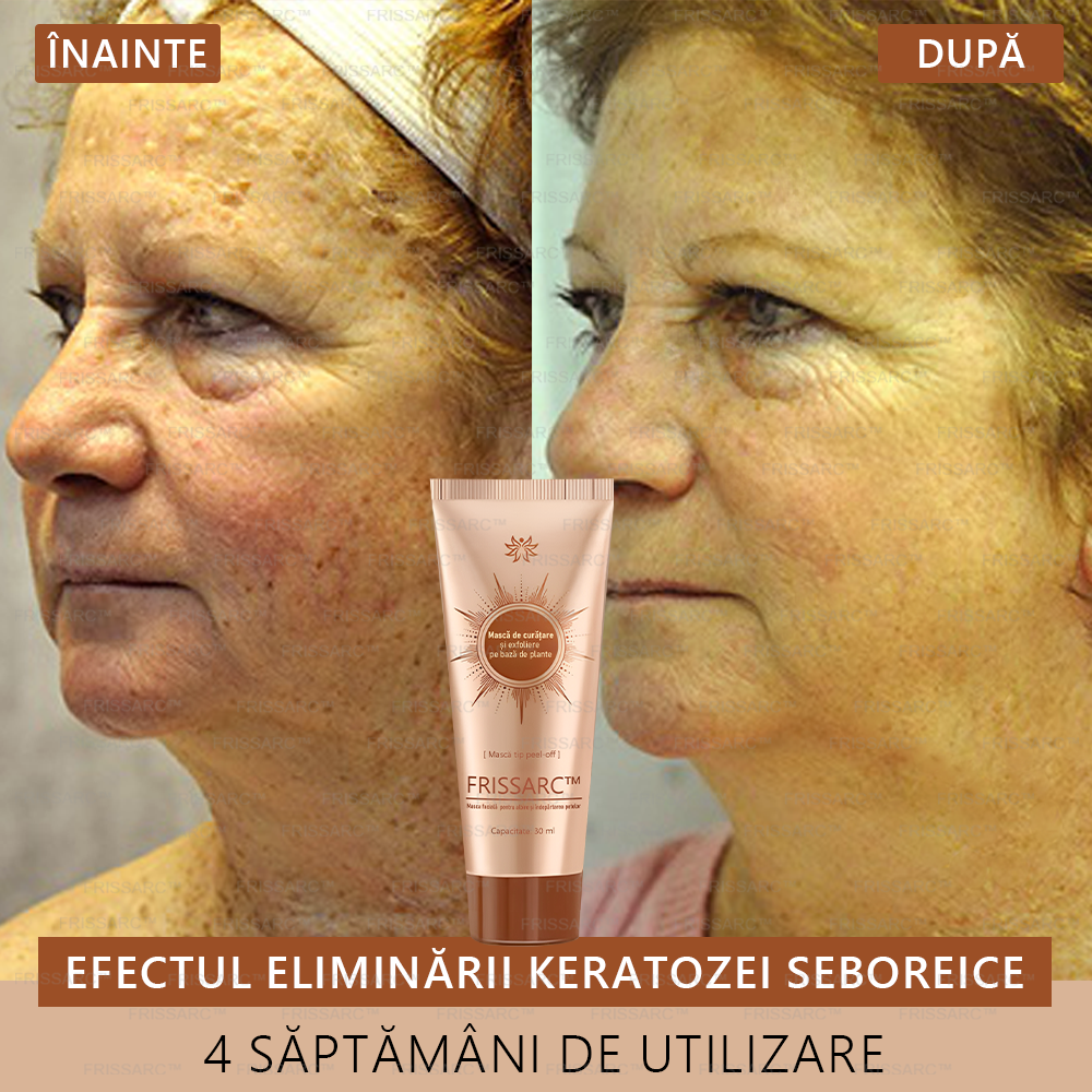 🎁FRISSARC™ masca facială  pentru albire și îndepărtarea petelor –🍀Ingredientele naturale ajută la eliminarea eficientă și de durată a petelor pigmentare, petelor de vârstă, pistruilor și petelor solare.🎁